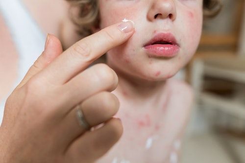 Top 10 Common Skin Infections in Kids During Monsoon and How to Prevent Them -ReviveHospital