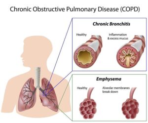 Asthma vs. COPD Key Differences Every Patient Must Know-revivehospitals