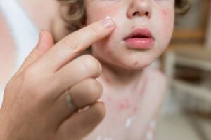 Top 10 Common Skin Infections in Kids During Monsoon and How to Prevent Them -ReviveHospital