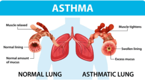 Asthma vs. COPD Key Differences Every Patient Must Know-revivehospitals