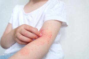 Eczema in Children- Symptoms, Causes-Revive Hospitals