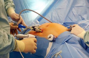 General Surgery vs. Laparoscopy- Which Is Safer and More Effective-Revive Hospitals